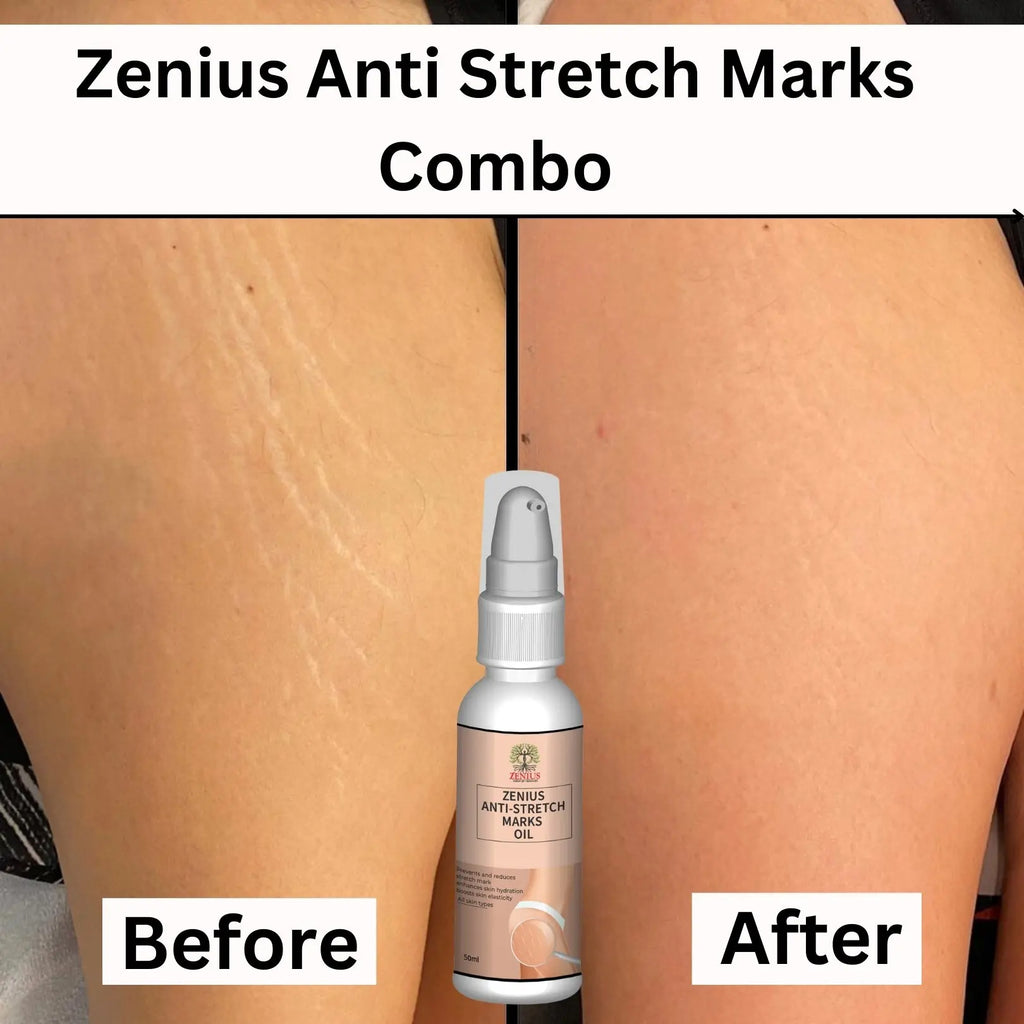 Anti Stretch Marks oil in Delhi