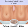 anti stretch marks cream